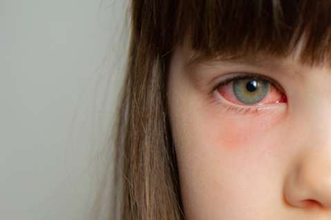 What is Conjunctivitis or Pink Eye?