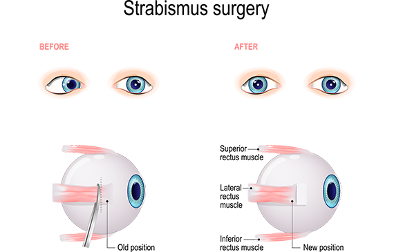 Adult Strabismus diagram