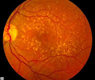 Retina scan showing the effects of age-related macular degeneration