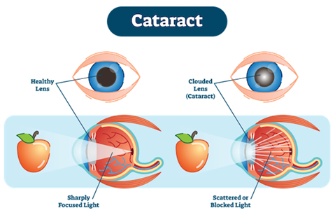 Cataract Surgery diagram