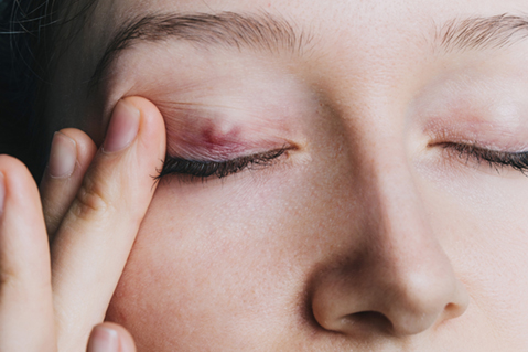 young girl shows a chalazion on the eyelid closeup