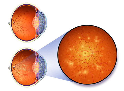 Diagram of Diabetic Retinopathy