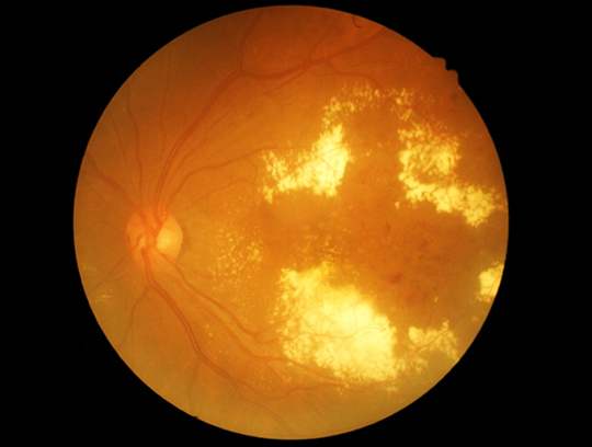 Retina scan showing diabetic retinopathy