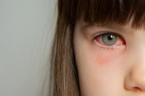 Pink eye Conjunctivitis in a girl's eye