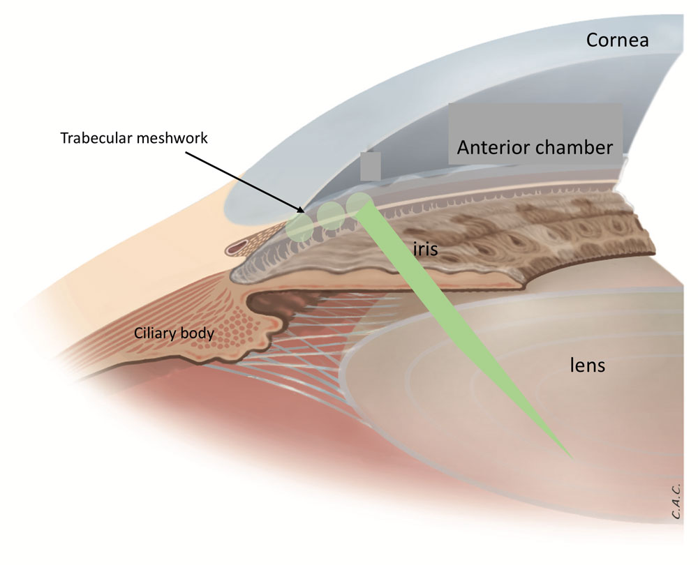 Glaucoma digram