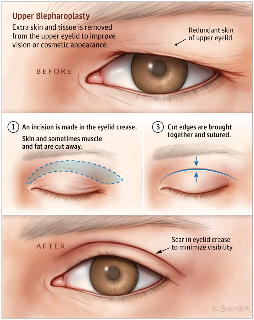 Upper eyelid surgery diagram