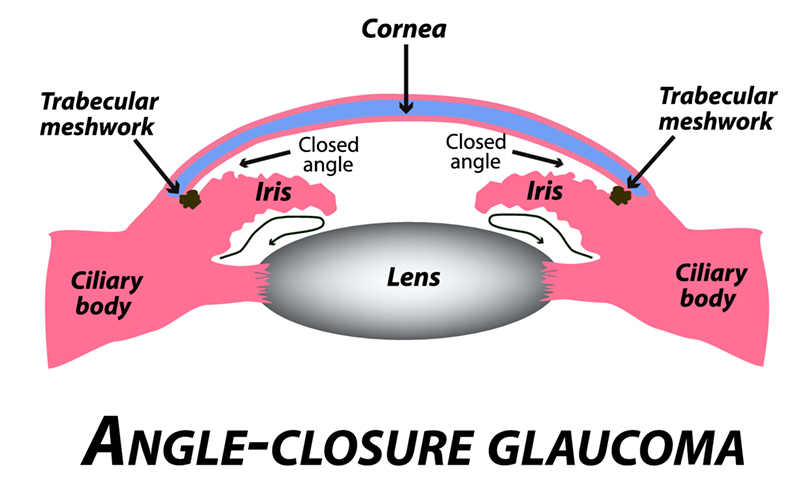 Closed Angle Glaucoma