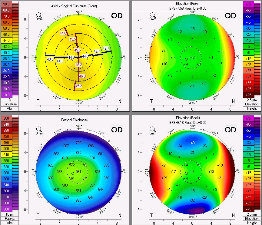 Corneal topography