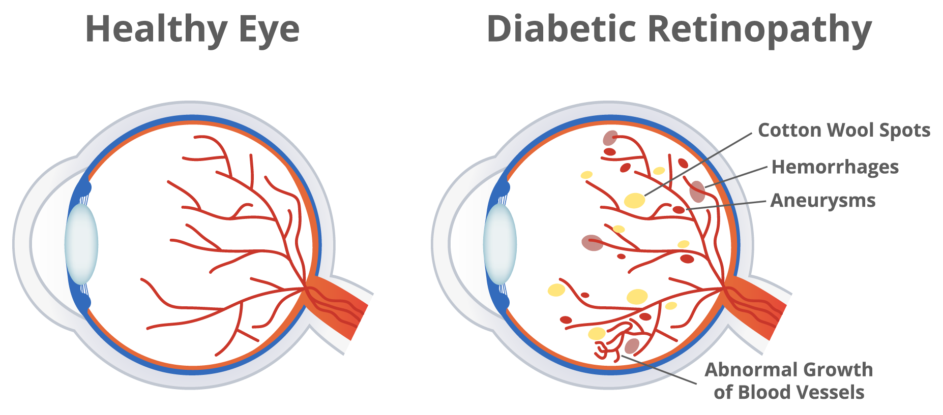 Medical illustration of healthy eye vs. eye with diabetic retinopathy