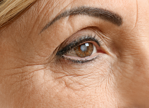 Mature woman with cataract