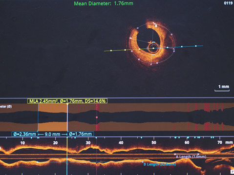 Optical coherence tomography (OCT)