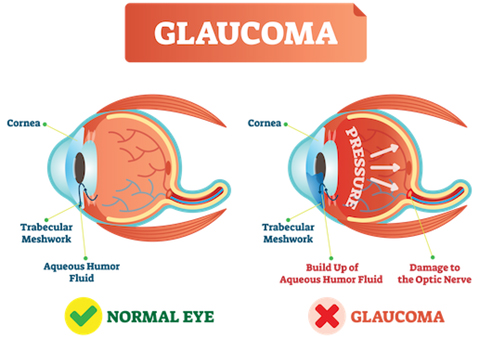 GLAUCOMA 第2版 volume 2のみ Selective Laser Trabeculoplasty (SLT) for Glaucoma | Eye