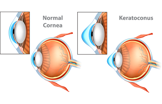 Medical illustration of a normal cornea vs a cornea with keratoconus