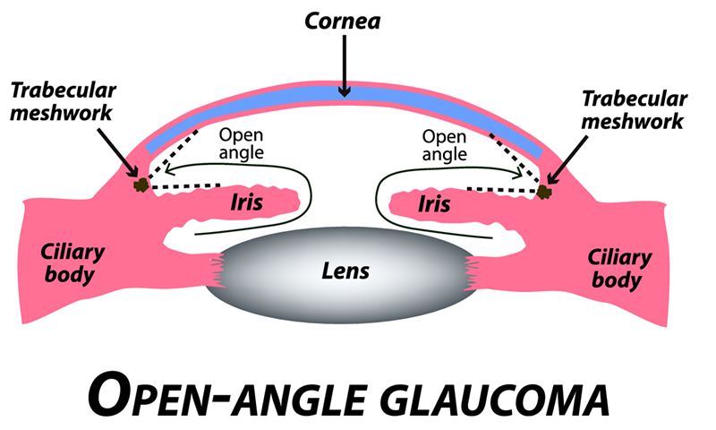 Open Angle Glaucoma